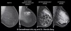 Dense Breast