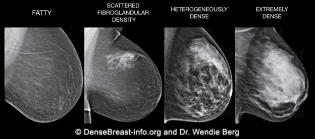 Dense Breast 