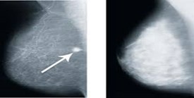 xray of dense breast